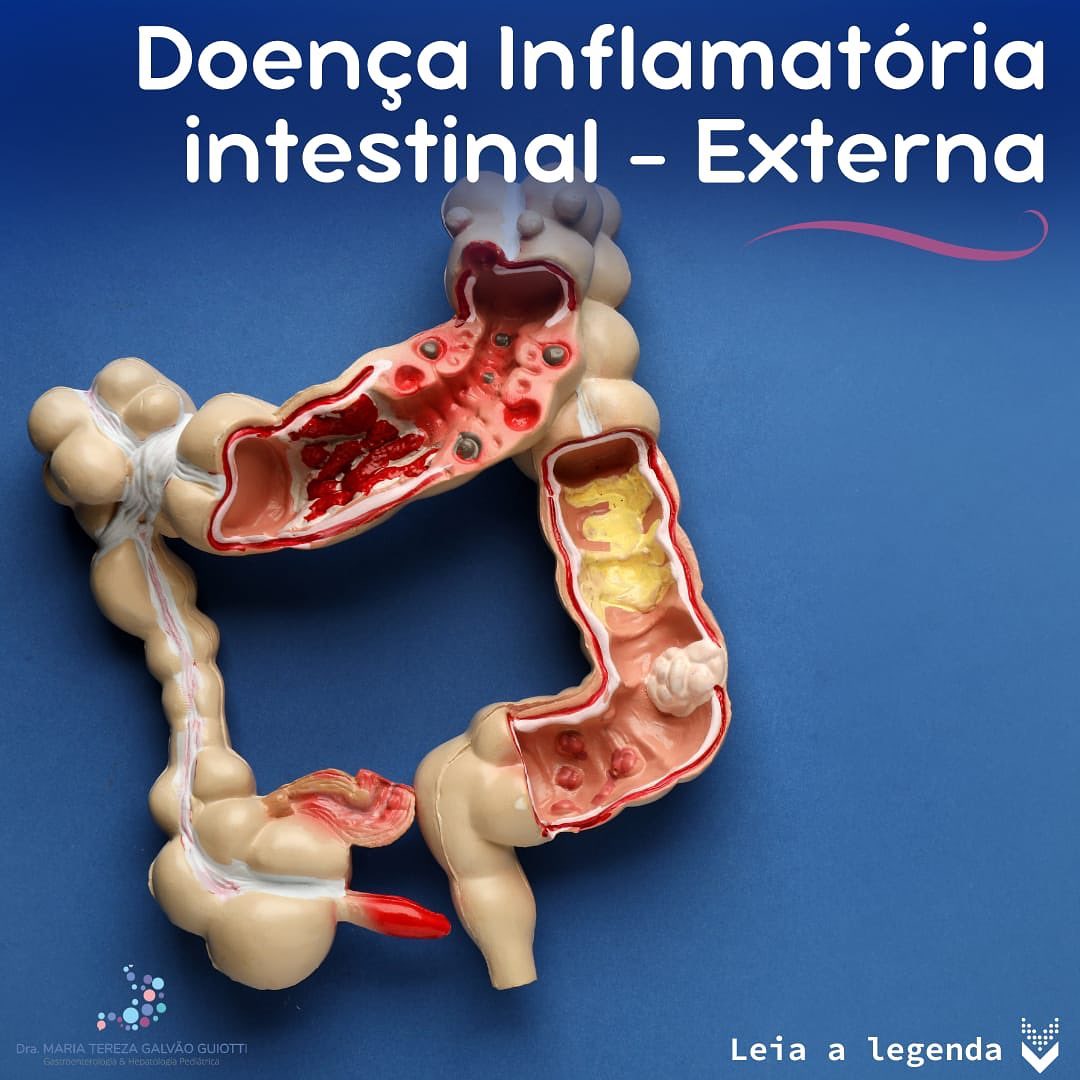 Doenças Inflamatórias Intestinais e seus sinais externos, pop pediatria, dra maria tereza, sintoma, intestino, vermelhidão, inchaço, ferimentos, tratamento