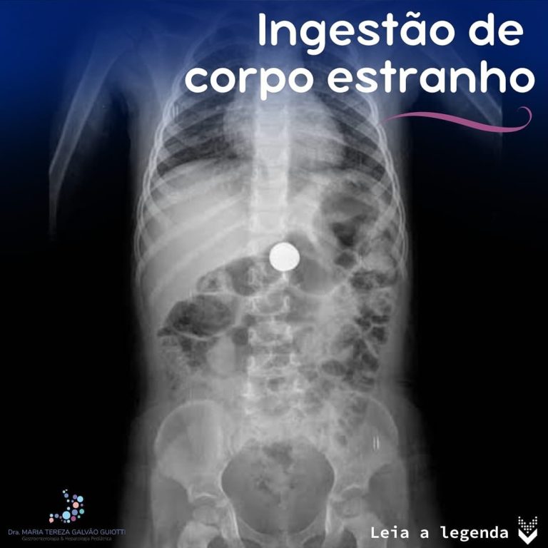 Ingestão de corpo estranho - Dra. Maria Tereza Pediatra ...